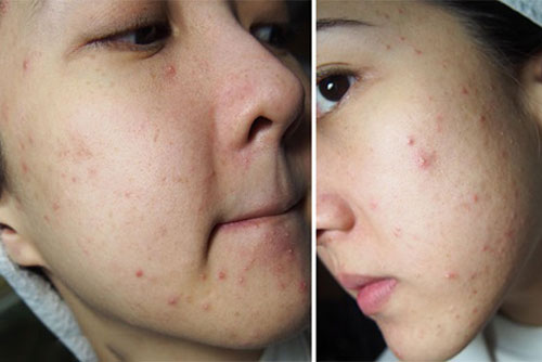 Cách trị mụn bọc cứng đầu, xấu xí trong vòng 3 ngày