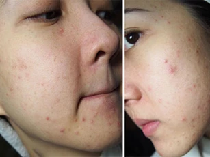 Cách trị mụn bọc cứng đầu, xấu xí trong vòng 3 ngày