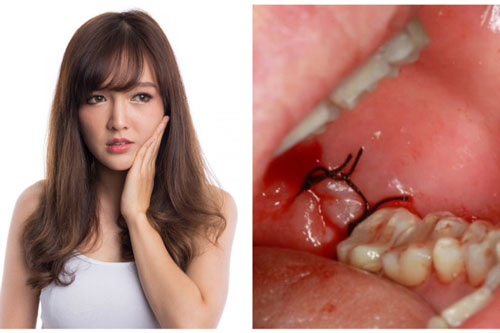 4 thời điểm "độc" tuyệt đối không được nhổ răng kẻo mang vạ vào thân, nguy hiểm ập đến bất ngờ