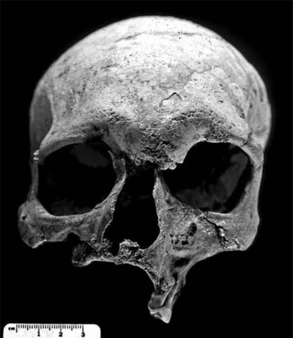 Xương sọ của bệnh nhân bị phong từ 4000 năm trước.