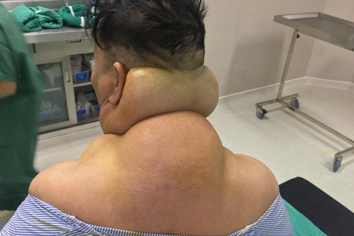 Yên Bái: Người đàn ông bị biến dạng cơ thể sau nhiều năm nghiện rượu