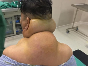 Yên Bái: Người đàn ông bị biến dạng cơ thể sau nhiều năm nghiện rượu
