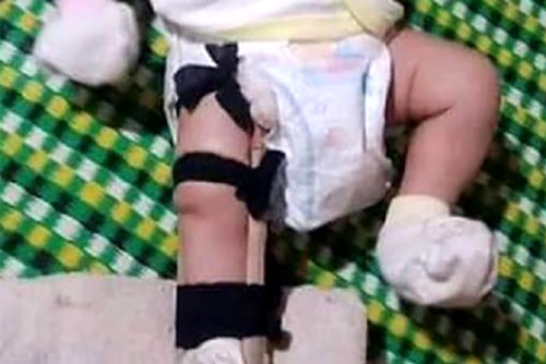 Bình Phước: Bé 2 tháng tuổi bị cha ruột "sơ ý dẫm gãy chân"?