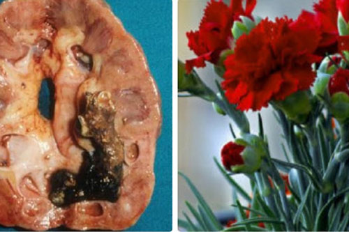 Thầy thuốc Đông y chia sẻ bài thuốc quý 'nạo sạch' sỏi thận, có thể trị dứt điểm trong vòng 1 tuần