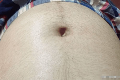 Phụ nữ mang thai mọc nhiều lông trên bụng có phải dấu hiệu sẽ sinh bé trai?