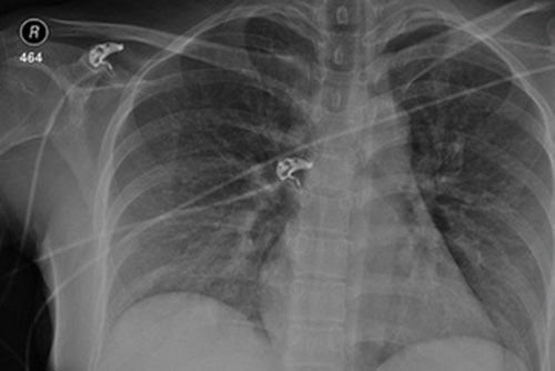 Cô gái bị bắn xuyên ngực nhưng vẫn sống sót nhờ "vật bảo hộ" không ngờ đến