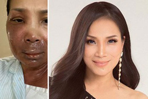 Nghệ sĩ Việt sốc khi Hồng Ngọc chia sẻ khuôn mặt bị bỏng nghiêm trọng