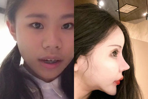 Gương mặt biến dạng của 10X phẫu thuật thẩm mỹ 60 lần từ năm 13 tuổi