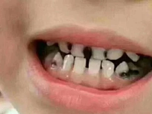 Miệng bé 3 tuổi đầy 'răng đen', không phải vì đường, mà là hai thói quen này của nhiều bố mẹ