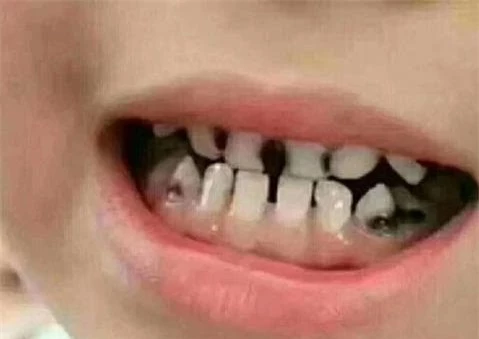 trẻ sâu răng 4