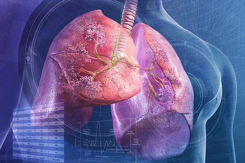 Thấy cơ thể có 2 chỗ lồi và 3 chỗ đen sạm, cẩn thận phổi đang "thủng lỗ chỗ" từng ngày