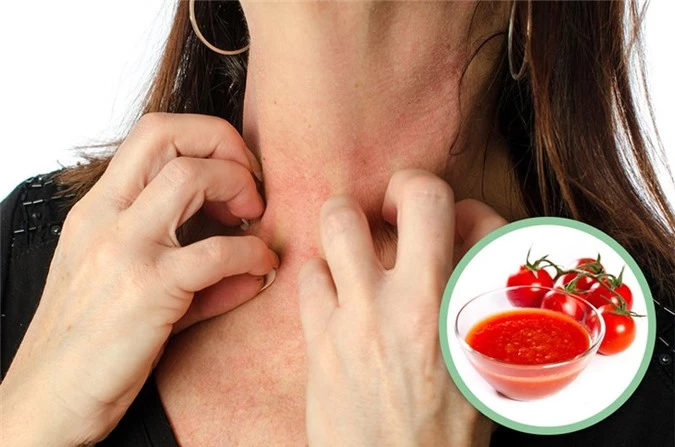 9 tác dụng phụ khi ăn quá nhiều cà chua, điều số 8 nguy hiểm nhất có thể mất mạng - 6
