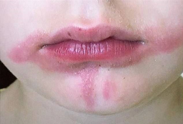 Cậu bé bỏng khắp miệng sau khi ăn kem chanh, nguyên nhân khiến gia đình bất ngờ