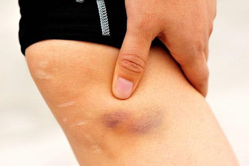 Mẹo giúp bạn xóa vết bầm tím chỉ trong 1 ngày