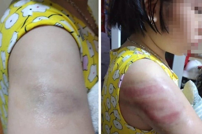 Cô đánh trò bầm tím tay vì viết chậm: Điều không nên xảy ra ở trường học