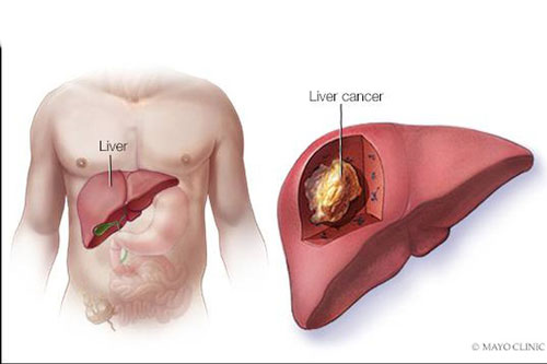 3 bệnh ung thư “sát thủ” hàng đầu với đàn ông Việt