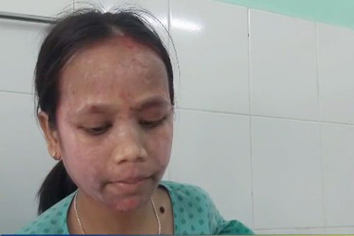 Sưng phù, lở loét mặt do sử dụng sản phẩm làm trắng da trên mạng