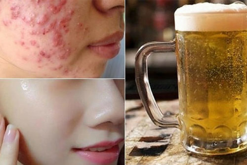Trị mụn bọc, trứng cá và trẻ hóa làn da chỉ bằng 1 lon bia, liệu bạn có biết?