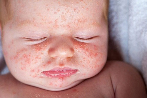 Mụn trứng cá ở trẻ sơ sinh là gì, mách mẹ cách điều trị hiệu quả tại nhà