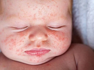 Mụn trứng cá ở trẻ sơ sinh là gì, mách mẹ cách điều trị hiệu quả tại nhà