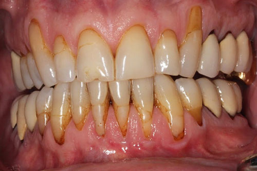 Thuốc lá điện tử có thể gây viêm nướu, các bệnh răng lợi khác