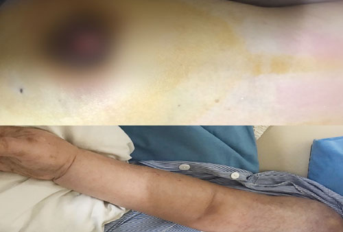 Đắp lá chữa ung thư vú, một phụ nữ bị di căn xương giai đoạn cuối