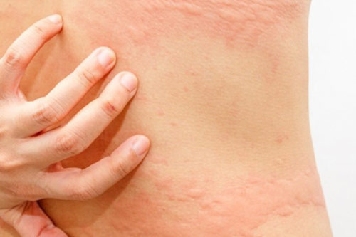 Mách bạn cách trị ngứa sâu róm hiệu quả nhất