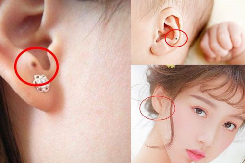 Tướng nốt ruồi ở tai quý như kim cương, ai có được là phúc lộc trọn đời
