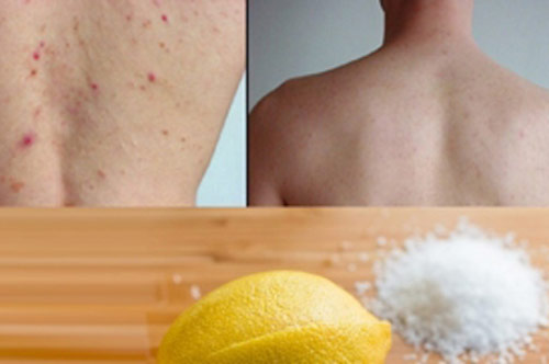 3 cách trị mụn lưng cấp tốc, hiệu quả cao tại nhà mà bạn gái nào cũng nên biết