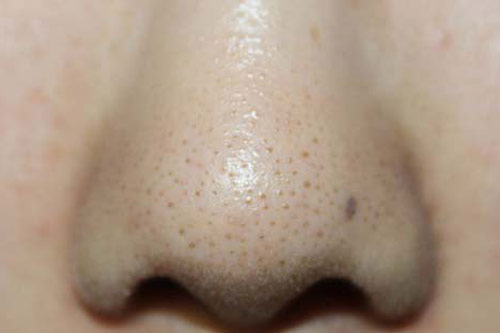 Chỉ với 1 quả chanh và bát nước đá, bạn có thể "đánh bay" vĩnh viễn mụn cám, mụn đầu đen