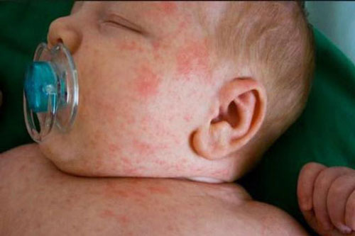 6 loại lá tắm trị rôm sảy các mẹ hay dùng cho bé trong mùa nóng