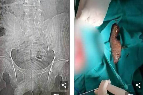 Ngồi không quan sát bị cá 'khủng' chui tọt vào trực tràng