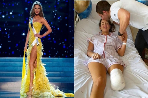 Hoa hậu Colombia lộ diện sau cưa chân