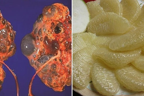 Thải độc gan, lọc sạch thận nhờ ăn 6 loại trái cây phổ biến, lại có thể phòng được bệnh tim, tránh ung thư