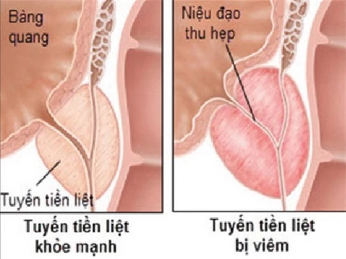 Hán liên thảo phối hợp với vị thuốc khác chữa viêm tuyến tiền liệt.