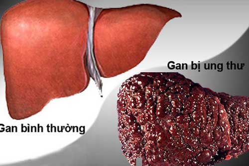 Không phải rượu bia, đây mới là "sát thủ" số 1 gây ung thư gan