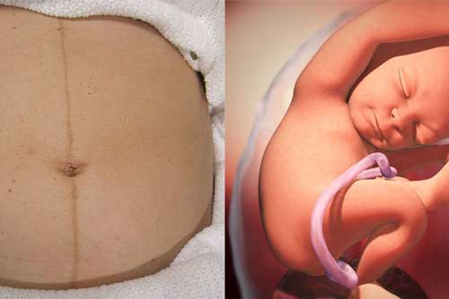 Tiết lộ bất ngờ về đường sọc nâu mẹ bầu nào cũng có trên bụng khi mang thai