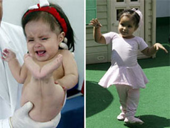 Vén màn bí ẩn về những em bé “tiên cá” có thật trong lịch sử