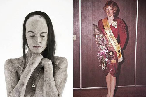 Hành trình "tái sinh" của hoa hậu bị bỏng 85% cơ thể: "Tôi sống trong làn da ấy"