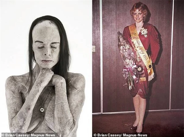   Cô Carol Mayer trong một bức ảnh chụp chân dung (trái) được thực hiện bởi nhiếp ảnh gia Brian Cassey, và bức ảnh được chụp hồi cô trở thành Hoa hậu North Aspley hồi năm 1983 (phải)  