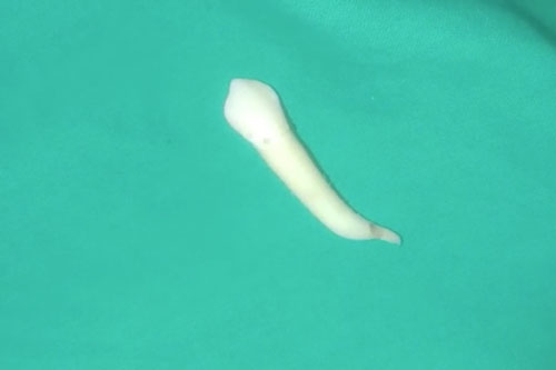 Chiếc răng gần 4cm phá kỷ lục răng dài nhất thế giới nhổ từ miệng bệnh nhân