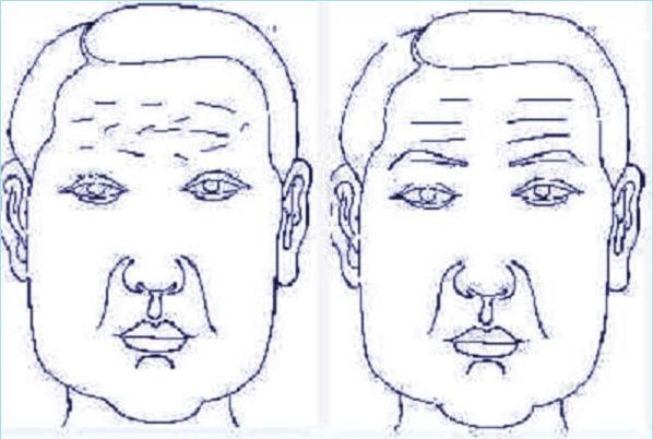 Dựa vào 7 nếp nhăn trên trán đoán được vận số sang hèn