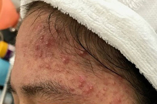 Cách phòng tránh mụn trứng cá và một số bệnh da liễu trong mùa Hè