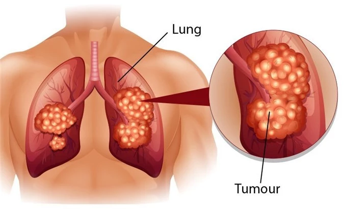 Ung thư phổi có nguy cơ di truyền từ thế hệ trước sang thế hệ sau.