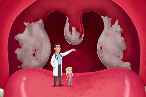 Bệnh bạch hầu: Triệu chứng ban đầu và cách phân biệt với viêm họng cấp