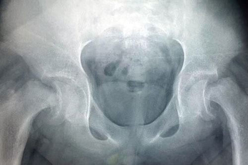 Ngã khi chơi đá bóng, trẻ bị trượt cả chỏm xương đùi hai bên