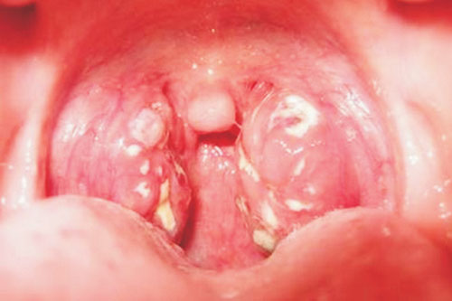Nhiều biến chứng của bệnh bạch hầu có thể khiến người mắc tử vong