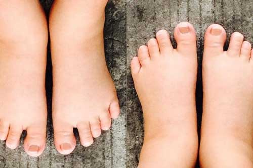 Mẹ bầu bị phù chân nên ăn gì?