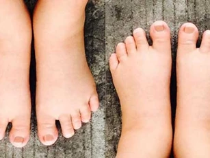 Mẹ bầu bị phù chân nên ăn gì?