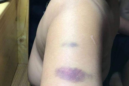 Giáo viên trường quốc tế đánh học sinh bầm tím tay